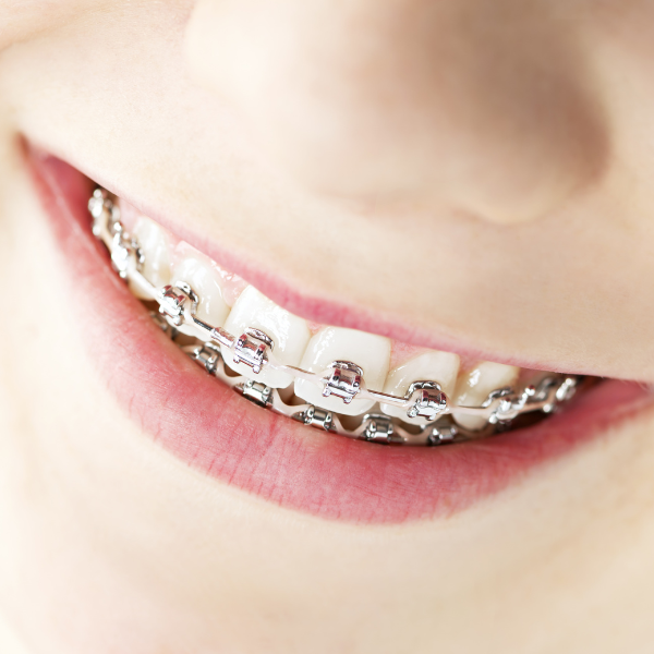 Paciente con brackets metálicos en Córdoba