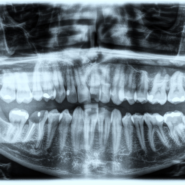 Tratamientos avanzados de endodoncia
