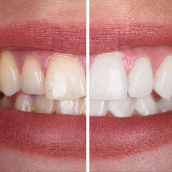 Blanqueamiento dental