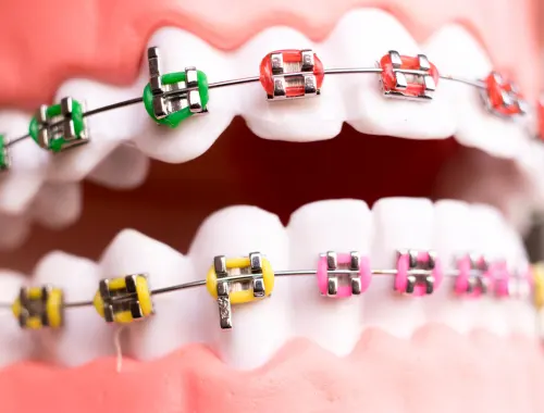 Brackets metálicos