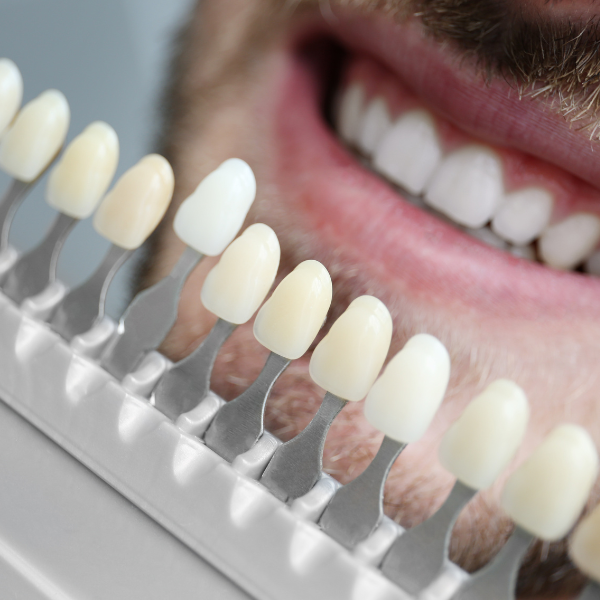 Carillas dentales