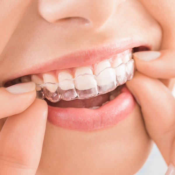 Invisalign